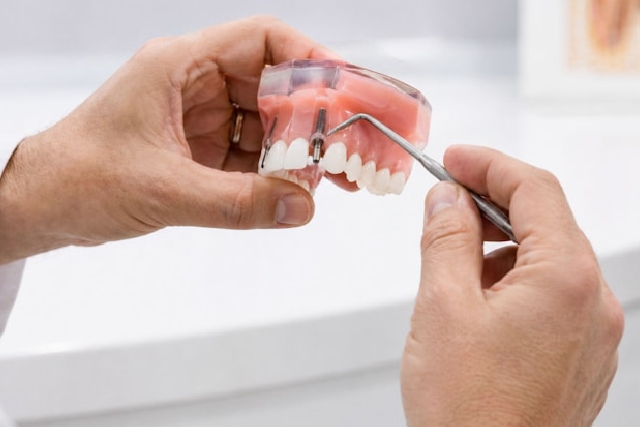 Prothèses fixes en céramique : allier beauté et bien-être au quotidien